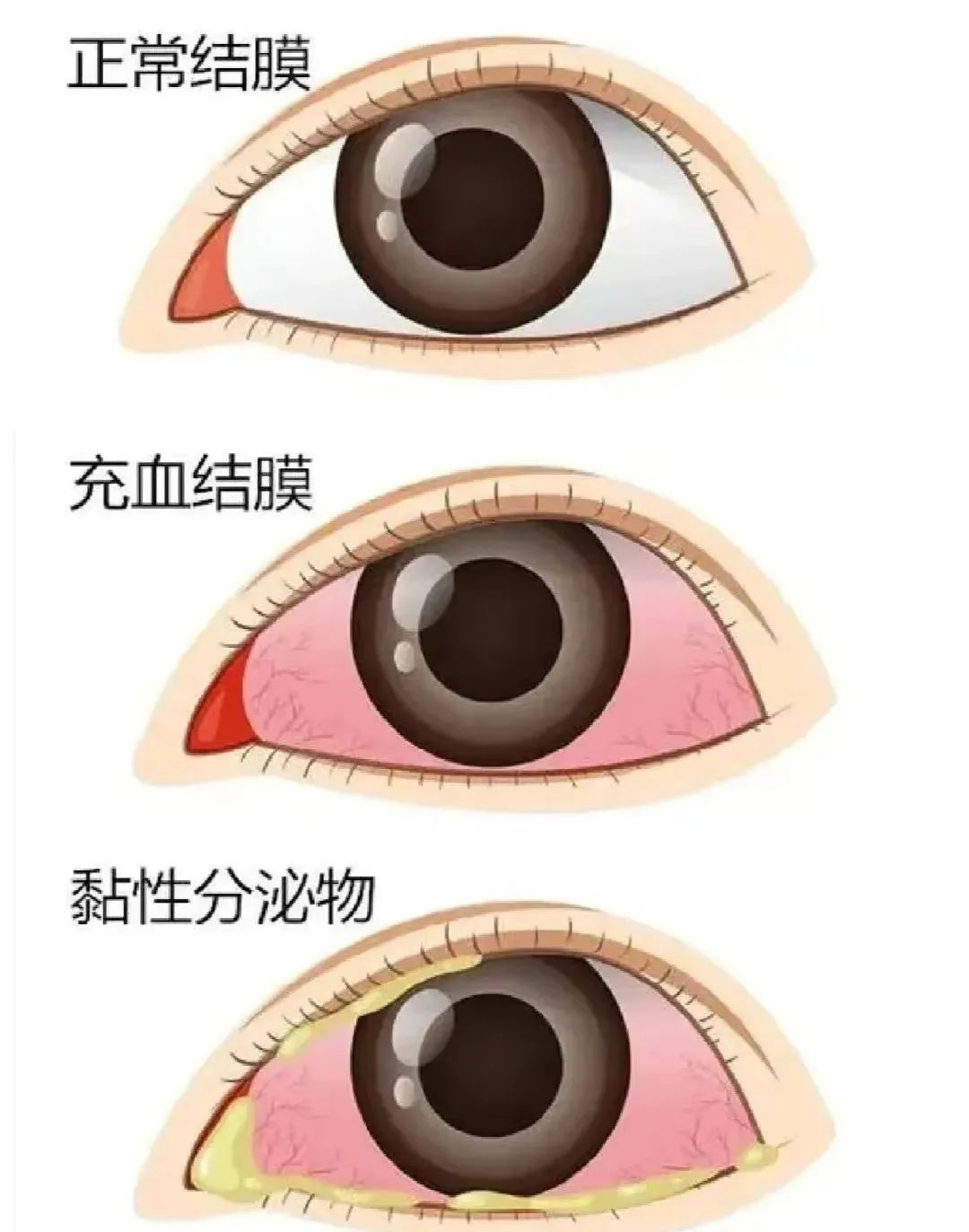 預防“紅眼病”，呵護眼健康——海口市山高幼兒園急性結(jié)膜炎預防知識宣傳活動-圖片11
