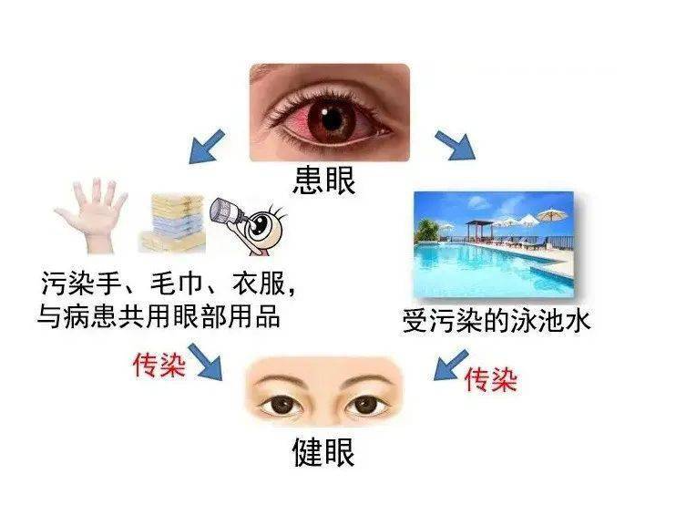 預防“紅眼病”，呵護眼健康——?？谑猩礁哂變簣@急性結(jié)膜炎預防知識宣傳活動-圖片21